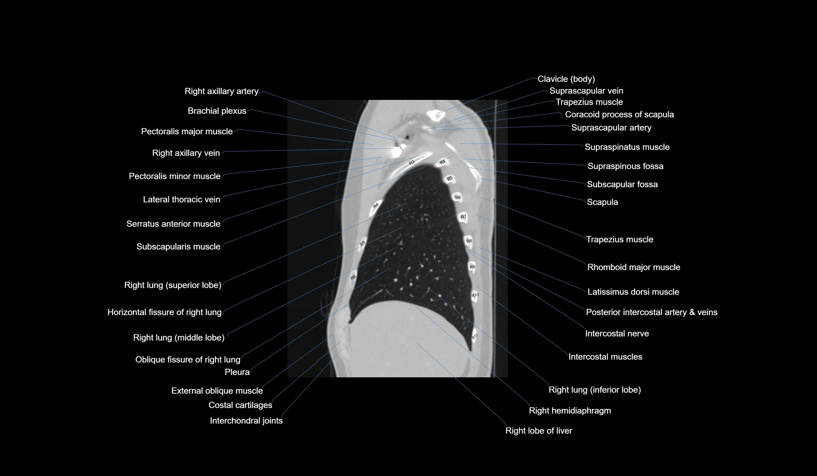 CT chest (thorax) labelled sagittal cross sectional anatomy radiology image-00030.webp